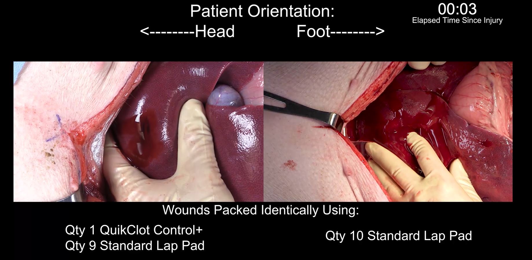 QuikClot Control+® Hemostatic Device - Liver Injury in a Swine Model